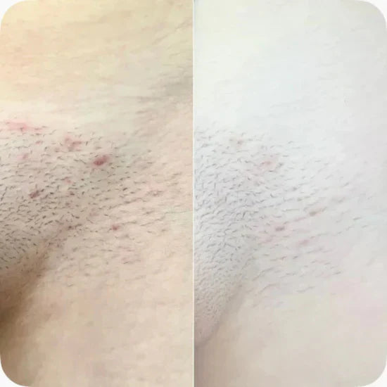 SilkCure™ - Glatt, strålende hud på bare 5 minutter