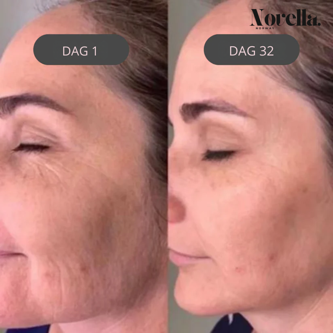 DermaLift™ – Huden din, strammere og yngre