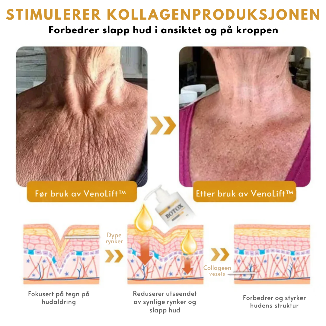 VenoLift™ – Strammere hud. Glattere konturer. Gjenvunnet selvtillit.