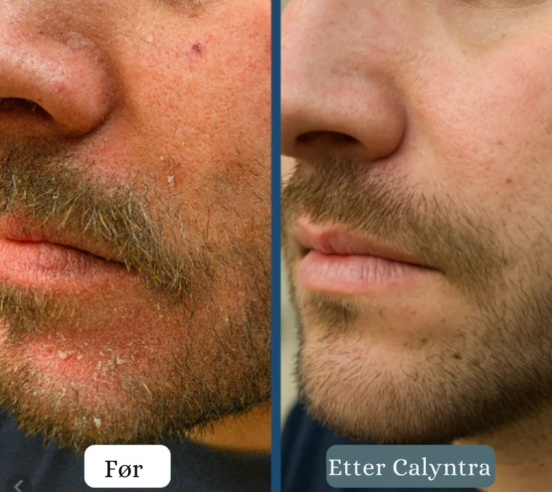 Calyntra™ – Den milde løsningen mot vedvarende rødhet, kløe og flass