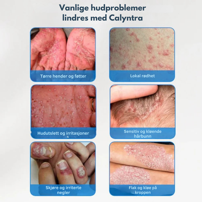 Calyntra™ – Den milde løsningen mot vedvarende rødhet, kløe og flass