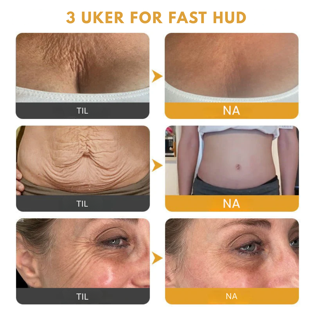 VenoLift™ – Strammere hud. Glattere konturer. Gjenvunnet selvtillit.