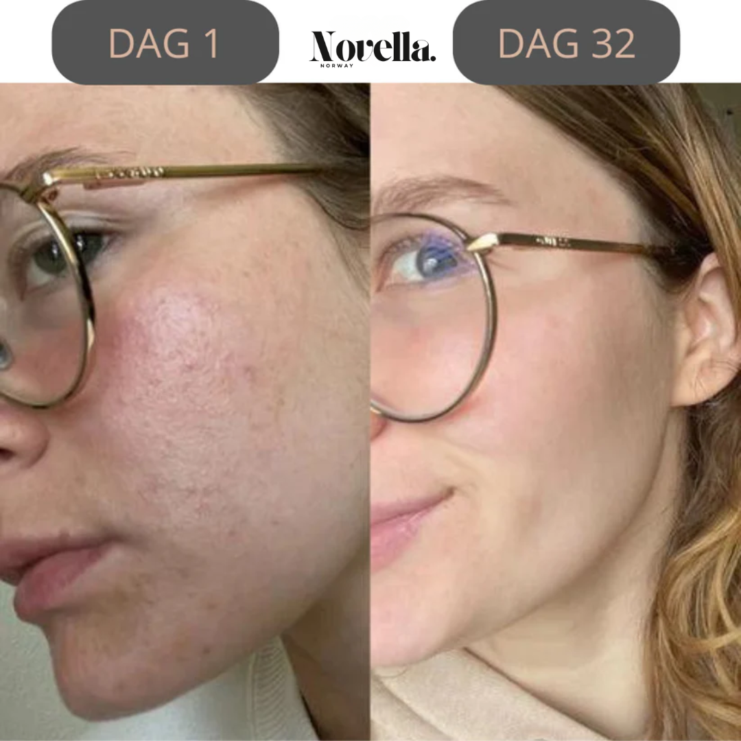 DermaLift™ – Huden din, strammere og yngre