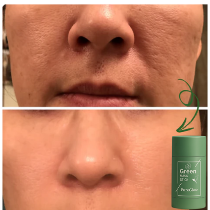 PureGlow™ Rensepinne | Bli kvitt kviser og få feilfri hud på 5 dager!